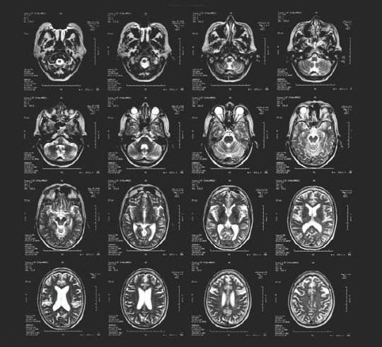 ▲사진과 같은 뇌 스캔을 통해 사이코패스들은 충동제어와 감정처리를 담당하는 뇌 영역에 결함이 있다는 사실이 밝혀졌다.