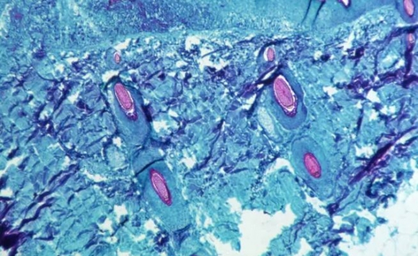 원숭이두창 바이러스에 감염된 피부 조직 모습