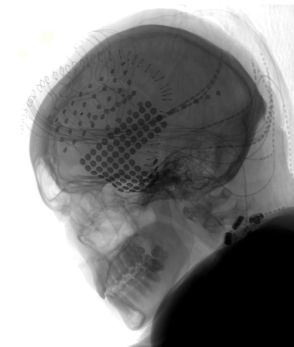 실험에 참여한 한 참가자의 머리 엑스레이 사진. 뇌의 전두엽(상단) 및 관자놀이(하단) 영역에 설치한 전극이 보인다. 간질 발작을 분석하기 위해 진행한 수술의 결과다. 간질 환자들 중 몇몇은 음악성 실험에 자원해 도움을 주었다. [사진=UC Berkeley]